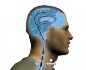 SGB treatment