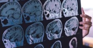 Vets with TBI at Increased Risk for Dementia