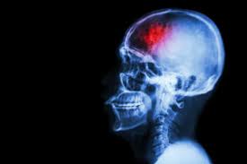 Veterans Can Qualify for Increased Disability due to TBI